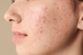 How to Get Rid of Pimples